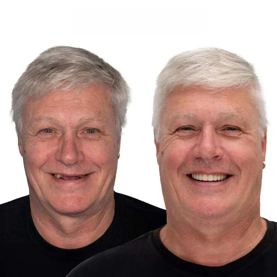 🔥Nidagene™ Custom-Fit Functional Dentures — Made in the USA, FDA Certified, Up to 70% OFF for a More Confident Smile!